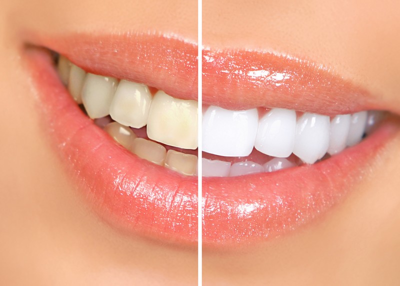 teeth whitening services Milford, CT